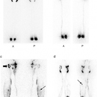 Gamagrafia de ganglios linfaticos. Linfogamagrafia. 920503 Idime (2024)