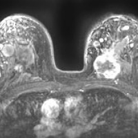 Resonancia nuclear magnetica de mama con contraste. 883351. Idime