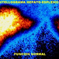 Gamagrafia de pool sanguineo hepatico. 920707 Idime (2024)