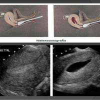 Ecografia pelvica ginecologica:histerosonografia o histerosalpingosonografia. 881410 Idime