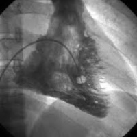 Ventriculografia de ventriculo derecho. 920403 Idime (2024)