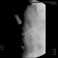 Sinografia o fistulografia de pared abdominal. 877400  Idime