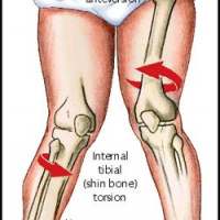 Tomografia computada de miembros inferiorires (anteversion femoral o torsion tibial). 879522  Idime. (2024)