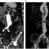 Angiotomografia con protocolo TAVI. Idime. (2024)