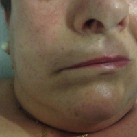 Electromiografia.Reflejo neurologico trigemino facial. 891503 Idime