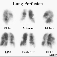 Gamagrafia pulmonar, perfusion y ventilacion.920304  Idime (2024)