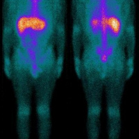 Gamagrafia de viabilidad tumoral con Octeotride.921301  Idime (2024)