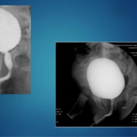 Uretrocistografia retrograda. 877863 Idime