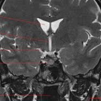 Resonancia nuclear magnetica de base de craneo-silla turca 883102. Idime. (2022)