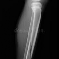 Radiografia en extremidades, proyecciones adiciones, oblicuas. 873444. Idime
