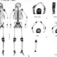 Recorrido corporal con I-131. Rastreo de metastasis. 920203. Idime (2024)
