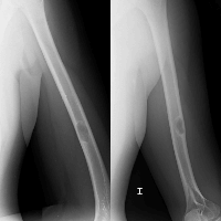 Radiografia de humero. 873121. Idime