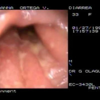 Sigmoidoscopia flexible o rigida. EN. Codigo CUPS 452401 (2022)