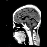 Tomografia computada de craneo simple y con contraste. EN. Codigo CUPS 879113 (2022)