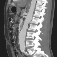 Tomografia computada de columna segmentos cervical, toracico, lumbar o sacro por cada nivel . Tres espacios  879201. Idime (2024)