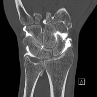 Artrotac de muñeca. 99902869. Idime. (2022)