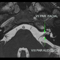 Resonancia nuclear magnetica de pares craneanos 883108. Idime (2022)