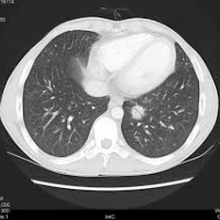 Tomografia axial computada simple de torax.879301 Idime