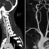 Angiotomografia carotidea y vertebral. 879901. Idime. (2022)