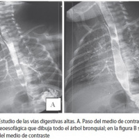 Radiografia de vias digestivas altas en niños (esofago, estomago, duodeno) y transito intestinal. 872123. Idime. (2024)