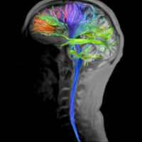 Resonancia de cerebro con tractografia.883106 Idime