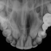 Radiografia de maxilar superior.870112 Idime