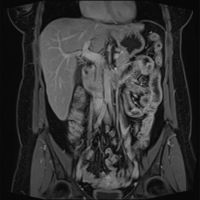 Resonancia nuclear magnetica de abdomen simple y contrastado. EN. Codigo 883401 SC (2022)