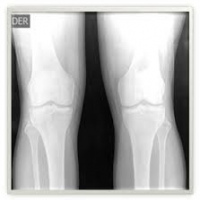 Radiografia de rodillas comparativas posición vertical únicamente vista AP. 873422 . Idime