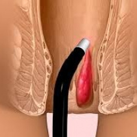 Ligadura de hemorroides con banda. Uniendoscopia (2023)