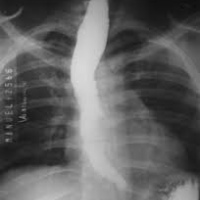 Radiografia de esofago. 871320  Idime