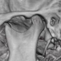 Tomografia computada de articulacion temporomandibular (bilateral). EN. Codigo CUPS 879150 (2022)