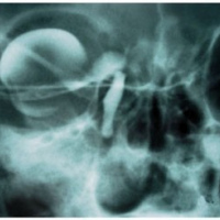 Dacriocistografia unilateral.874601  Idime