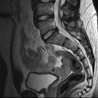 Resonancia nuclear magnetica sacrocoxigea. 883234. Idime