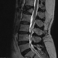 Resonancia nuclear magnetica de columna lumbosacra simple 883230. Idime (2022)