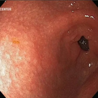 Endoscopia digestiva alta menor de 14 años con sedacion. Uniendoscopia (2023)