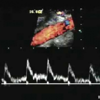 Ecografia doppler de aorta abdominal a color.882212 Idime