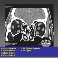 Tomografia computada de orbitas. EN. Codigo CUPS 879121 (2022)