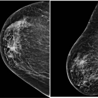 Ecografia de seno con implantes (glandulas mamarias). Ecografias Bogota (Mandalay)