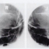 Radiografia de agujeros opticos.870103 Idime