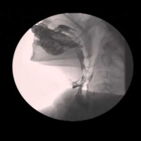 Radiografia de faringe. Faringografia. 870603 Idime