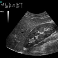 Ecografia de abdomen superior (higado, pancreas, vias biliares, riñones, bazo y grandes vasos). 881305 Idime