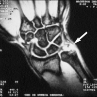 Artrorresonancia de muñeca. 878731. Idime