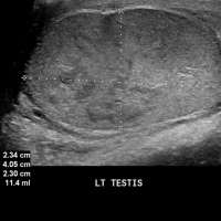 Ecografia testicular con analisis doppler. 881511 Idime