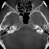 Tomografia Computada de oido, peñasco y conducto auditivo interno. EN. Codigo CUPS 879122 (2022)
