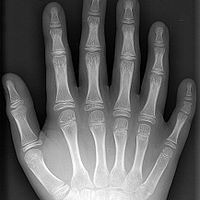 Radiografia de dedos en mano. 873210  Idime