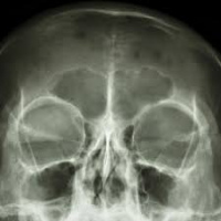 Radiografia de orbitas. 870102  Idime