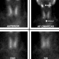 Gamagrafia con metaiodo Bencilguanidina (MIBG) . 920204 Idime (2024)