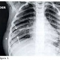 Radiografia de reja costal. 871111 Idime