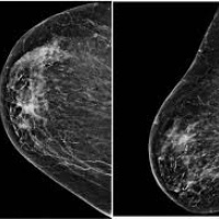 Ecografia diagnostica de mama con transductor de 7 MHZ o mas. 881201 Idime