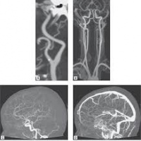 Resonancia nuclear magnetica con contraste para evaluacion dinamica de líquido cefalorraquídeo.883107 Idime